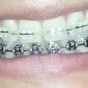 18 months into treatment. Debracing in about 4 week's time. A little gap has formed on top and bottom. They're addressing those issues with some clear elastic string. YAY!