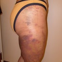 Thighs after 1 week