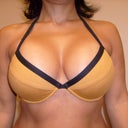 1week after augment and swollen