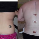 They removed 4 liters during the lipo on my flanks and mons area. Unbelievable.