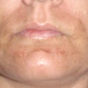 Sunday (Fraxel was on Friday)... peeling