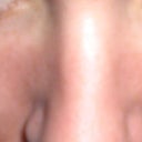 After Fraxel, next day - very puffy!