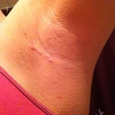 Left incision, 3 weeks