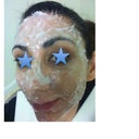 before laser with the numbing cream on my face.... 