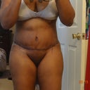 front view 4 days post op