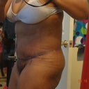 side view 4 days post op
