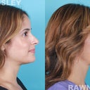 Revision Rhinoplasty