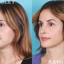 Revision Rhinoplasty