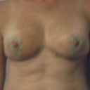 Drains Removed Post Op Day 8