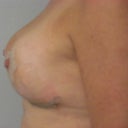 Drains Removed Post Op Day 8 Left Side