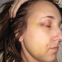 bruises 4 days after, green yellow black blue purple...