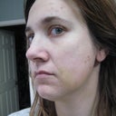 burn, welts, bruise, 4 days post