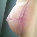 post op day 23. This is the open spot under my right breast, aka scary spot number 2. It looks much better, but I still don't really know what happened there.