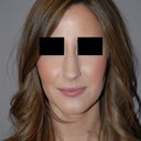 Before - frontal view