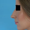 Before -  left profile