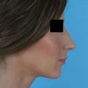 Before - right profile