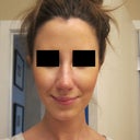 Day 7 - SPLINT OFF! - Very swollen front view