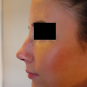 Day 7 -  SPLINT OFF! - left profile. My doctor says the remaining bump is just the skin retaining the shape of the old bump. Should go away with time.