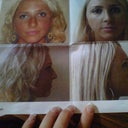 My "Before and After" Souvenir from the follow up (a month and a half after surgery). LOVE it!