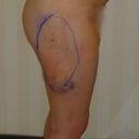 Notice the large bruise, this is the same place the bump is in the front view picture.