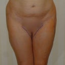 Another front view with my legs closed so it is more comparible to my preop photos