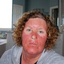 72 hours later - skin getting to feel like sandpaper