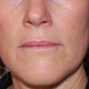 front - 1 year after