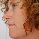 left side - before