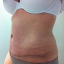 5 months PO  : (