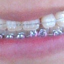 About 5 to 6 weeks into treatment. My teeth became so gapped. My lower teeth were so crooked in comparison to 17 months into treatment.