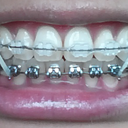Elastics were worn in this position for a few months to bring my pre molars together.