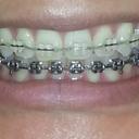 No elastics needed 14 months into treatment.