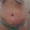 Front 3 week post op