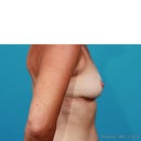 Before surgery