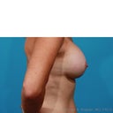 After surgery-6 weeks post op