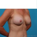 After surgery-6 weeks post op