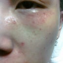Day 4: Swollen and patchy skin