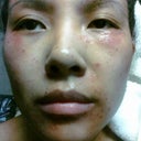 Dark red marks under eyes. Still swollen.