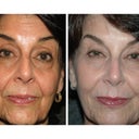 No-downtime "Liquid Lift" For Woman In Her Mid-60's