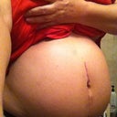 post Zerona swelling, other causes were ruled out by 13 medical specialists