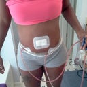 pod 11 swelling still present one drain removed today shower felt great yesterday