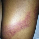 1 week post op bruising