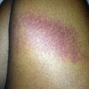 More bruising