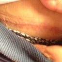 Right after I took them off!! The picture before this one shows the strips on!! So far so good, 6 days in!!