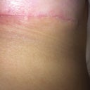 Suture holding up my healing process. My boss (ob/gyn) clipped it for me and it healed within days