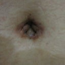 3 weeks post-op. bb up close, those inner bumps are firm, probably with swelling. as you can see, everything looks dark from the scarring, but I'm hoping it gets better.