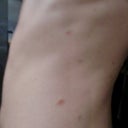 waist, pink spots looking larger than original brown spot