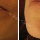 Starlux 1540 For Scar Removal And Skin Plumping