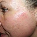 Day #7 Left side - as you can see, I still have some scar pigmentation as well as a raw spot near my temple.