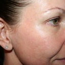 Day #7 Right side - on this side is very good improvement.  Skin is smoother, color is more even.
